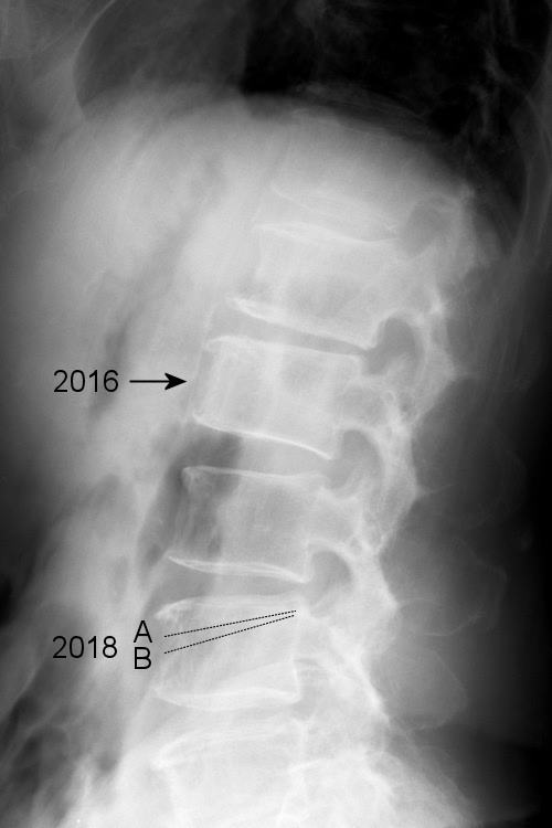 脊椎 X線写真